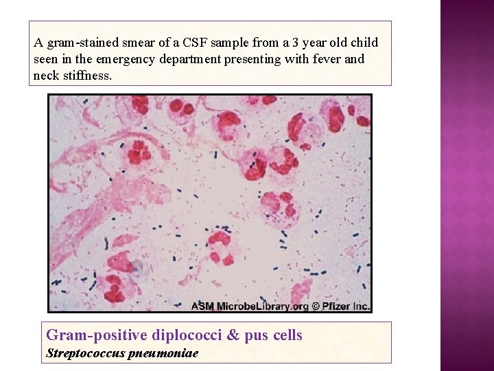 A gram-stained smear of a CSF sample from a 3 year old child seen