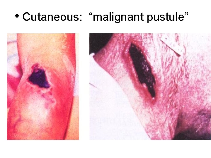  • Cutaneous: “malignant pustule” Textbook of Military Medicine 