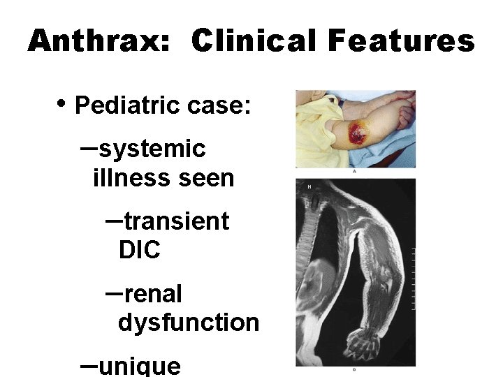 Anthrax: Clinical Features • Pediatric case: –systemic illness seen –transient DIC –renal dysfunction –unique