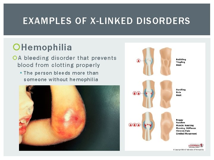 EXAMPLES OF X-LINKED DISORDERS Hemophilia A bleeding disorder that prevents blood from clotting properly
