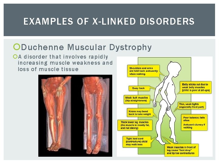 EXAMPLES OF X-LINKED DISORDERS Duchenne Muscular Dystrophy A disorder that involves rapidly increasing muscle
