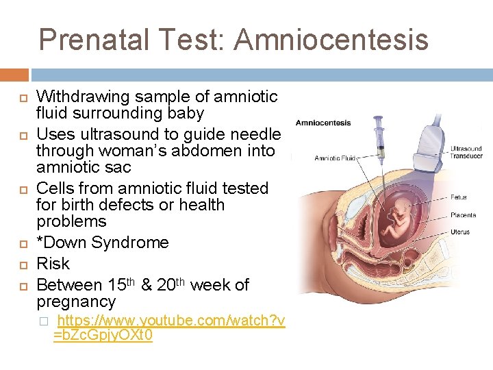 Prenatal Test: Amniocentesis Withdrawing sample of amniotic fluid surrounding baby Uses ultrasound to guide