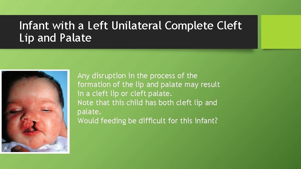 Infant with a Left Unilateral Complete Cleft Lip and Palate Any disruption in the