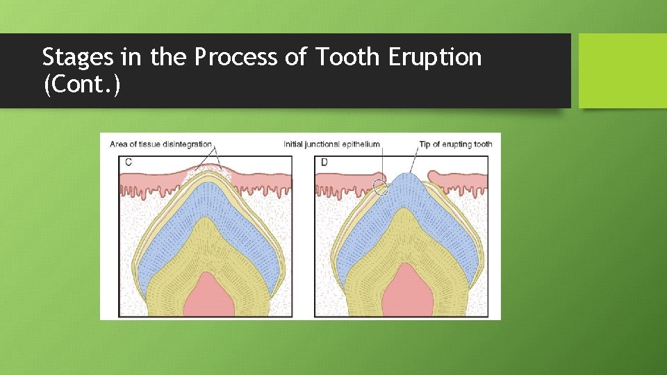 Stages in the Process of Tooth Eruption (Cont. ) 