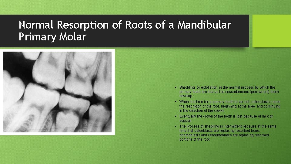 Normal Resorption of Roots of a Mandibular Primary Molar • Shedding, or exfoliation, is