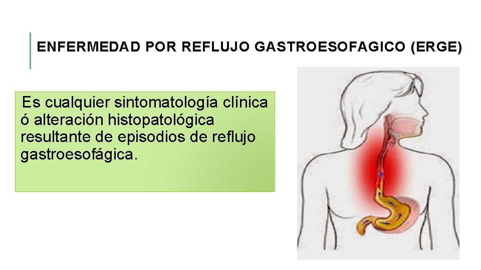 ENFERMEDAD POR REFLUJO GASTROESOFAGICO (ERGE) Es cualquier sintomatología clínica ó alteración histopatológica resultante de
