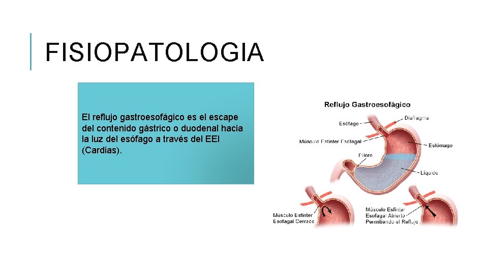FISIOPATOLOGIA El reflujo gastroesofágico es el escape del contenido gástrico o duodenal hacia la