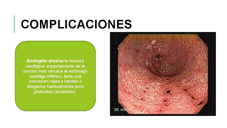 COMPLICACIONES Esofagitis erosiva la mucosa esofágica, especialmente de la porción más cercana al estómago