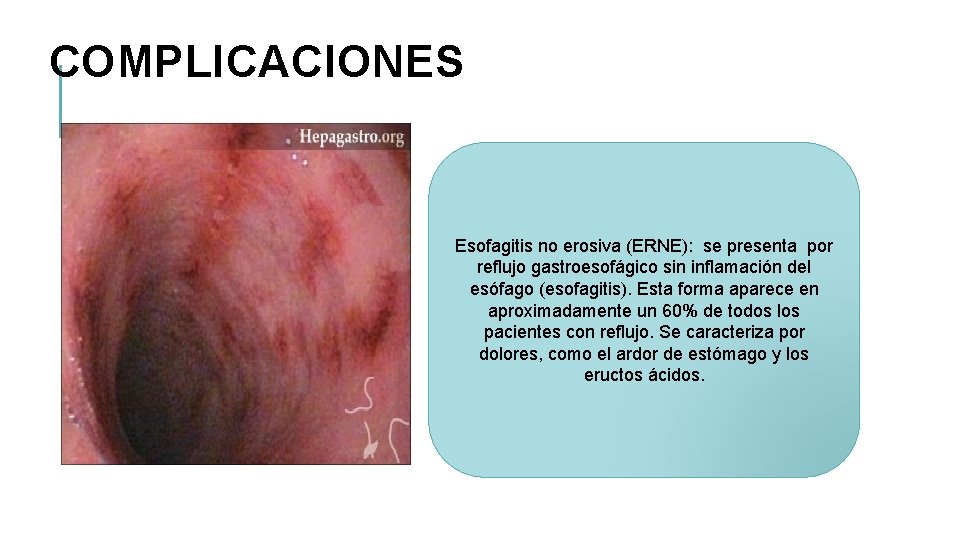 COMPLICACIONES Esofagitis no erosiva (ERNE): se presenta por reflujo gastroesofágico sin inflamación del esófago