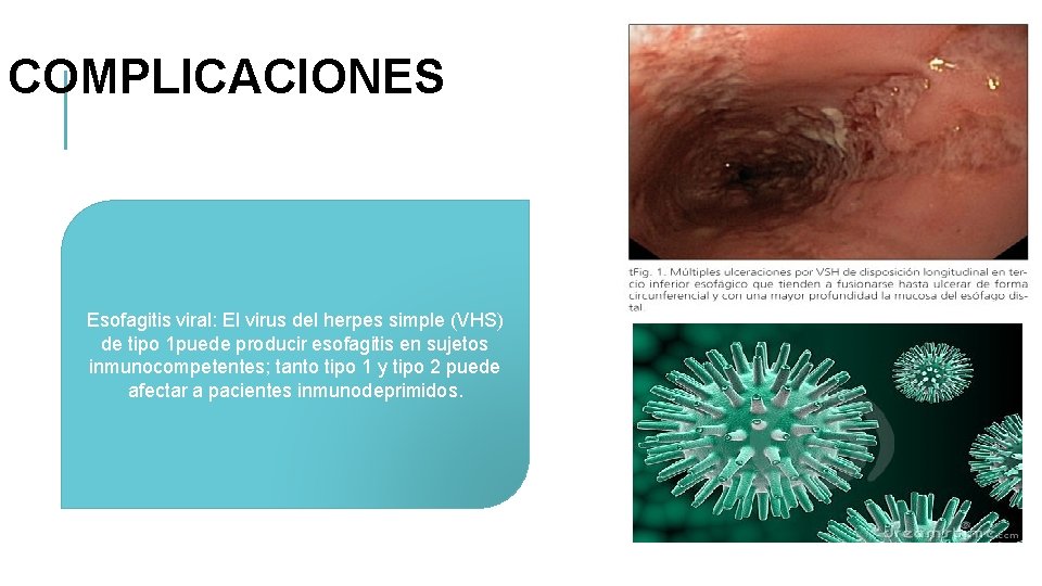 COMPLICACIONES Esofagitis viral: El virus del herpes simple (VHS) de tipo 1 puede producir