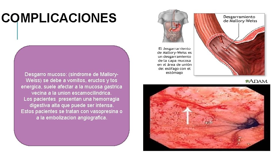 COMPLICACIONES Desgarro mucoso: (sindrome de Mallory. Weiss) se debe a vomitos, eructos y tos