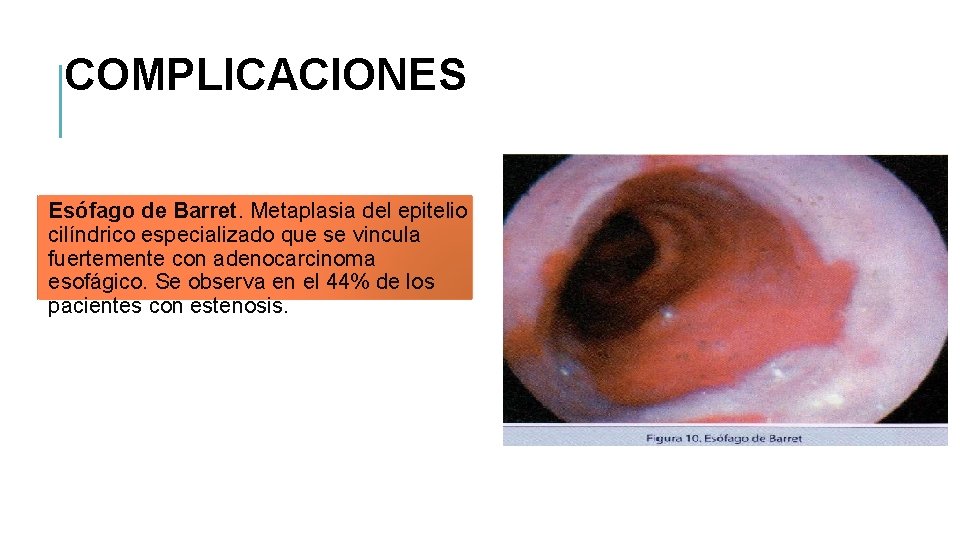 COMPLICACIONES Esófago de Barret. Metaplasia del epitelio cilíndrico especializado que se vincula fuertemente con