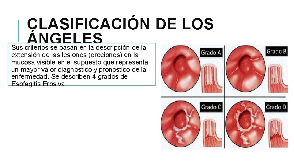 CLASIFICACIÓN DE LOS ÁNGELES Sus criterios se basan en la descripción de la extensión