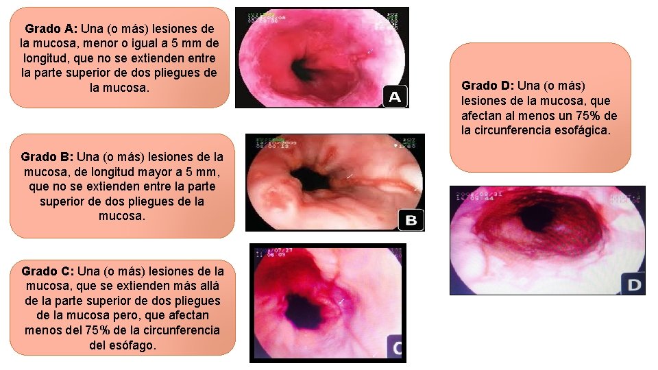 Grado A: Una (o más) lesiones de la mucosa, menor o igual a 5