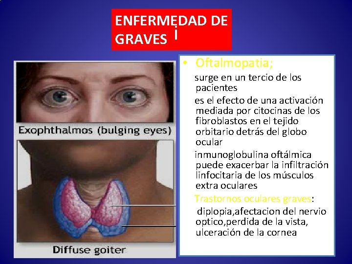 ENFERMEDAD DE GRAVES i • Oftalmopatia; surge en un tercio de los pacientes es