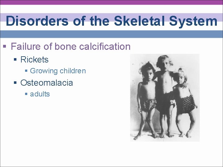 Disorders of the Skeletal System § Failure of bone calcification § Rickets § Growing