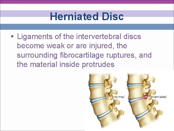 Herniated Disc § Ligaments of the intervertebral discs become weak or are injured, the