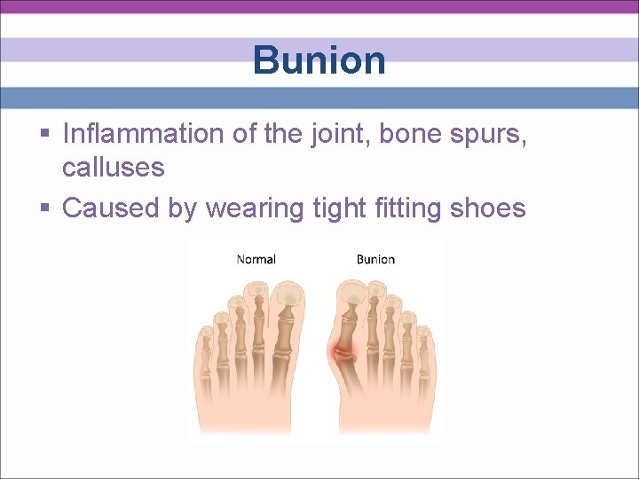 Bunion § Inflammation of the joint, bone spurs, calluses § Caused by wearing tight
