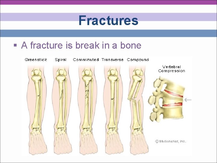 Fractures § A fracture is break in a bone 