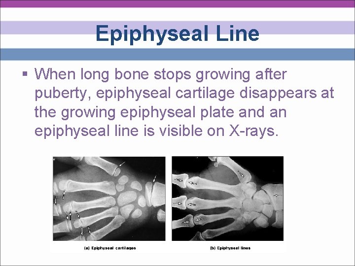 Epiphyseal Line § When long bone stops growing after puberty, epiphyseal cartilage disappears at