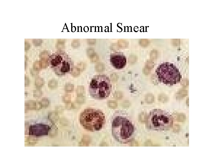 Abnormal Smear 