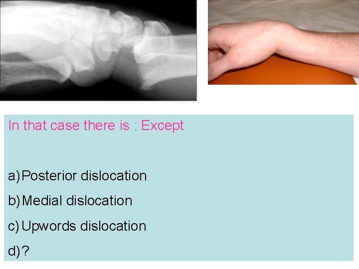 In that case there is : Except a) Posterior dislocation b) Medial dislocation c)