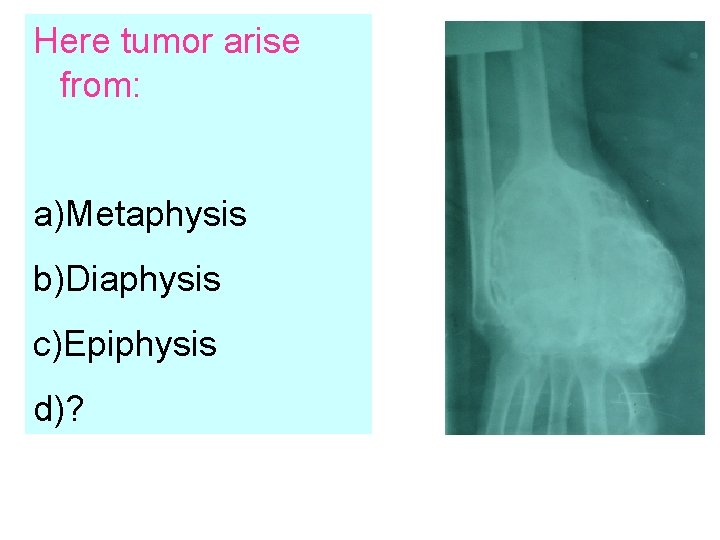 Here tumor arise from: a)Metaphysis b)Diaphysis c)Epiphysis d)? 