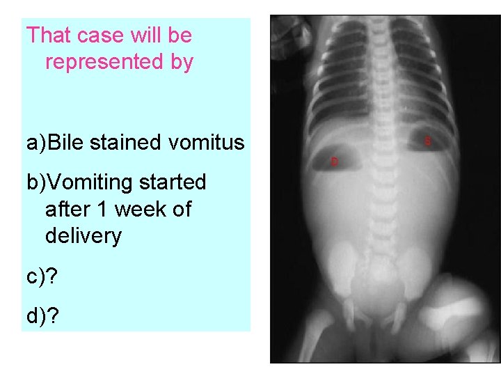 That case will be represented by a)Bile stained vomitus b)Vomiting started after 1 week