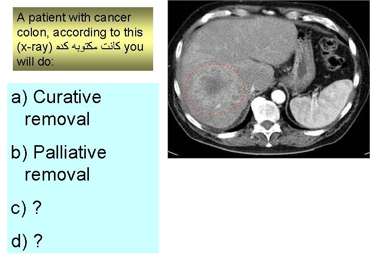 A patient with cancer colon, according to this (x-ray) ﻛﺎﻧﺖ ﻣﻜﺘﻮﺑﻪ ﻛﺪﻩ you will