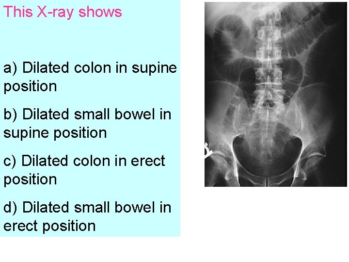 This X-ray shows a) Dilated colon in supine position b) Dilated small bowel in