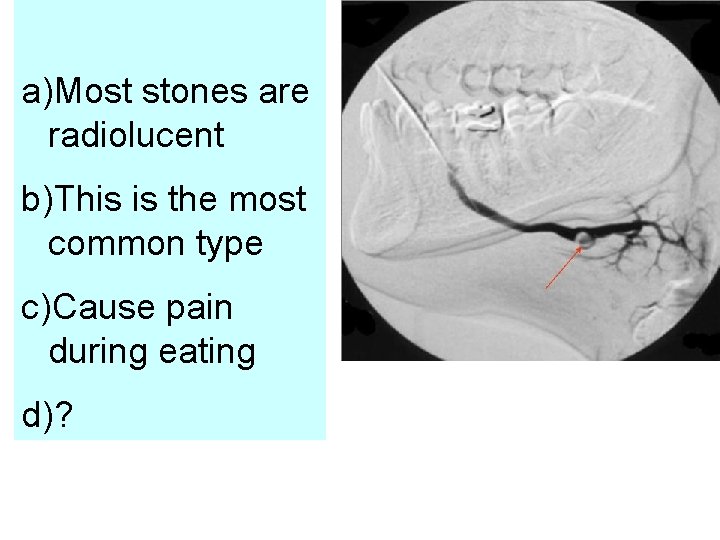 a)Most stones are radiolucent b)This is the most common type c)Cause pain during eating