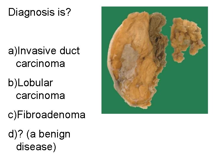 Diagnosis is? a)Invasive duct carcinoma b)Lobular carcinoma c)Fibroadenoma d)? (a benign disease) 