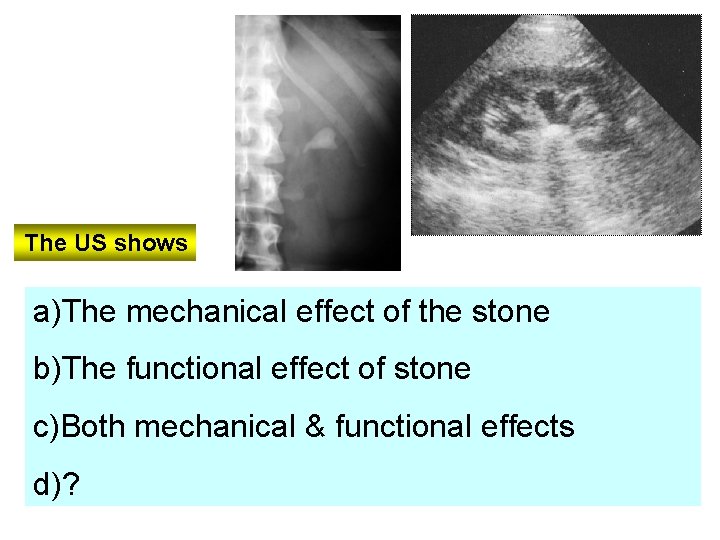 The US shows a)The mechanical effect of the stone b)The functional effect of stone