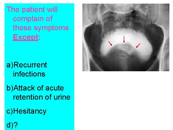 The patient will complain of these symptoms Except: a)Recurrent infections b)Attack of acute retention
