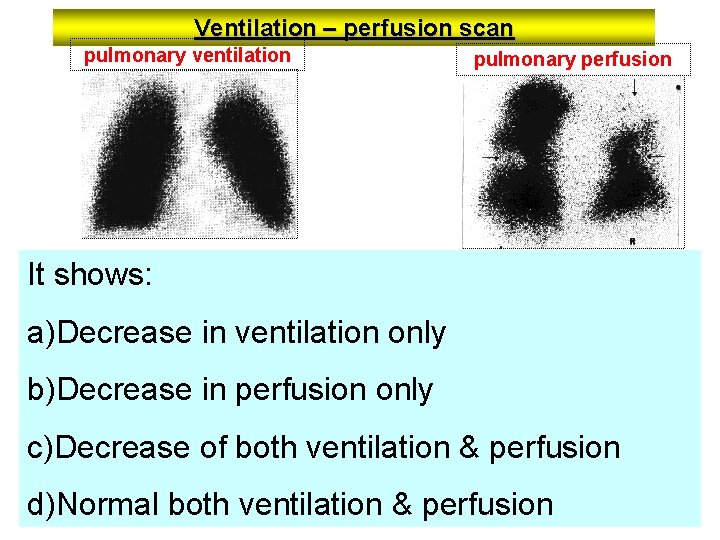 Ventilation – perfusion scan pulmonary ventilation pulmonary perfusion It shows: a)Decrease in ventilation only