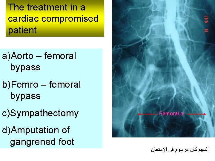 The treatment in a cardiac compromised patient a)Aorto – femoral bypass b)Femro – femoral