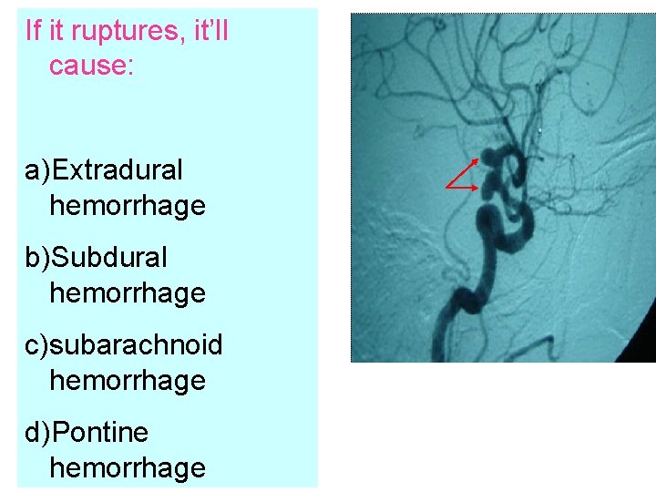If it ruptures, it’ll cause: a)Extradural hemorrhage b)Subdural hemorrhage c)subarachnoid hemorrhage d)Pontine hemorrhage 