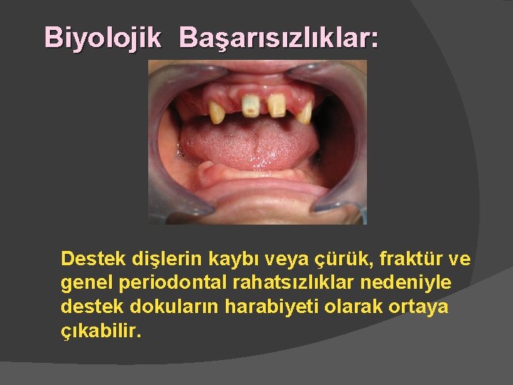 Biyolojik Başarısızlıklar: Destek dişlerin kaybı veya çürük, fraktür ve genel periodontal rahatsızlıklar nedeniyle destek