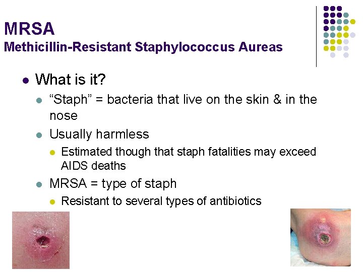 MRSA Methicillin-Resistant Staphylococcus Aureas l What is it? l l “Staph” = bacteria that