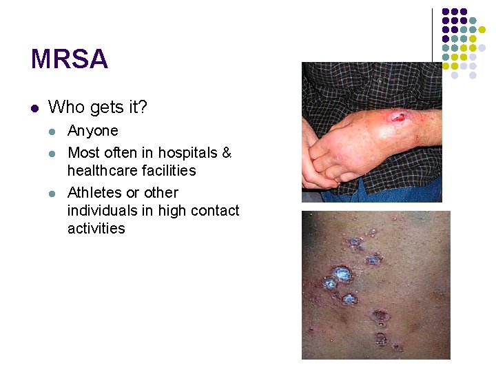 MRSA l Who gets it? l l l Anyone Most often in hospitals &