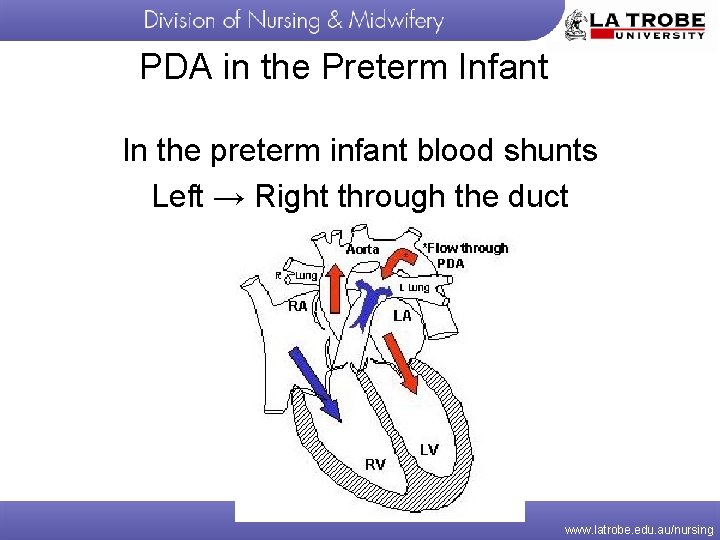 PDA in the Preterm Infant In the preterm infant blood shunts Left → Right