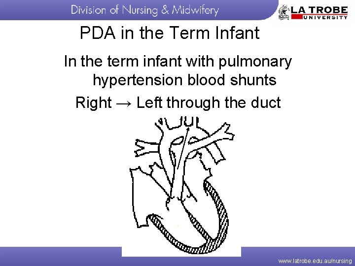 PDA in the Term Infant In the term infant with pulmonary hypertension blood shunts