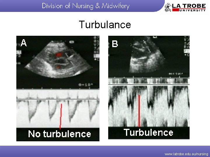 Turbulance www. latrobe. edu. au/nursing 