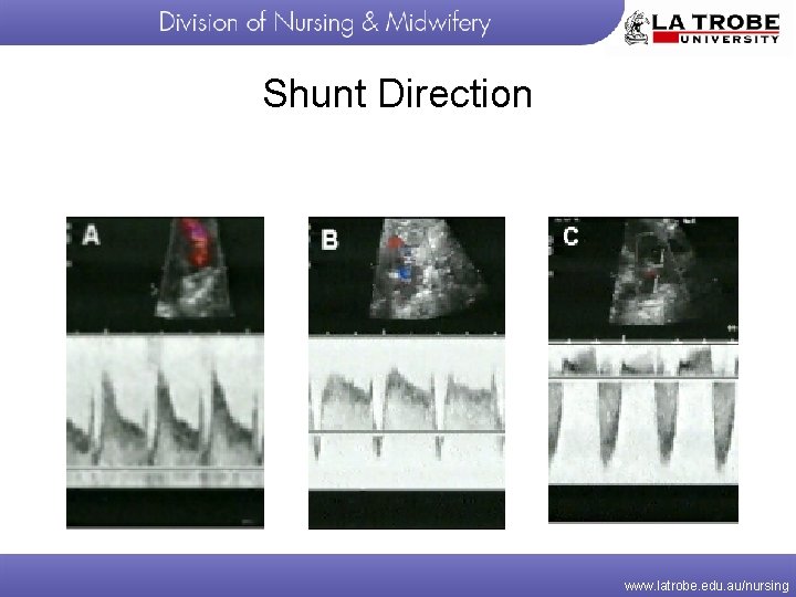 Shunt Direction www. latrobe. edu. au/nursing 