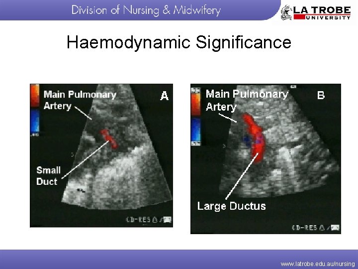 Haemodynamic Significance www. latrobe. edu. au/nursing 