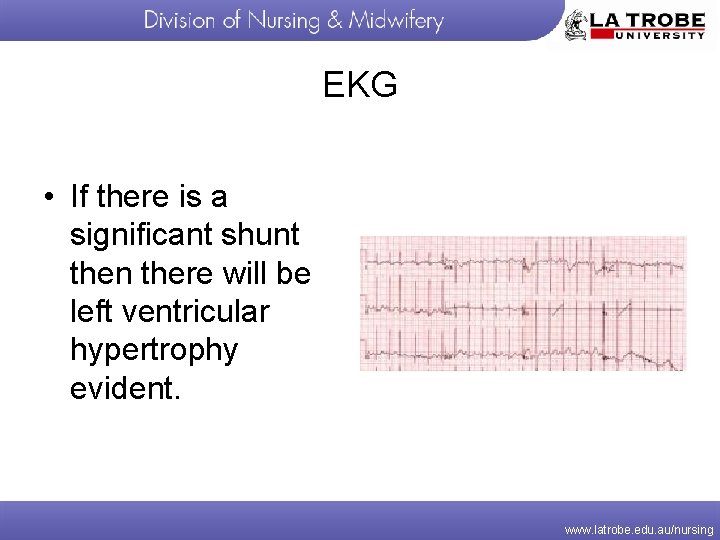 EKG • If there is a significant shunt then there will be left ventricular