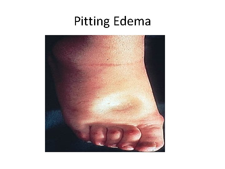 Pitting Edema 