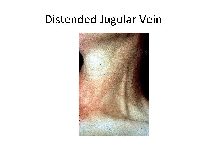 Distended Jugular Vein 