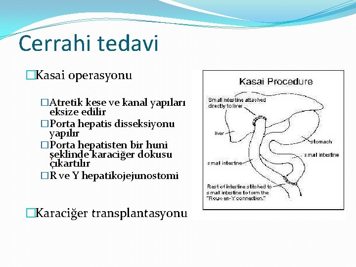 Cerrahi tedavi �Kasai operasyonu �Atretik kese ve kanal yapıları eksize edilir �Porta hepatis disseksiyonu