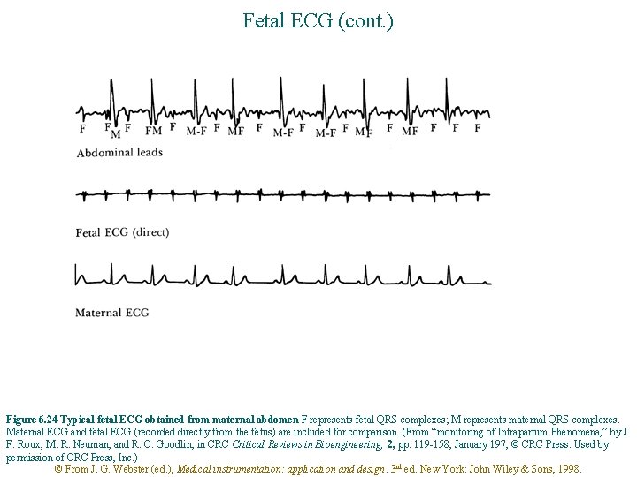 Fetal ECG (cont. ) Figure 6. 24 Typical fetal ECG obtained from maternal abdomen